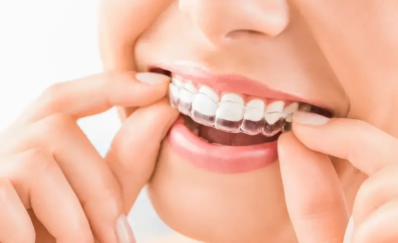 Zakończenie leczenia nakładkami Invisalign