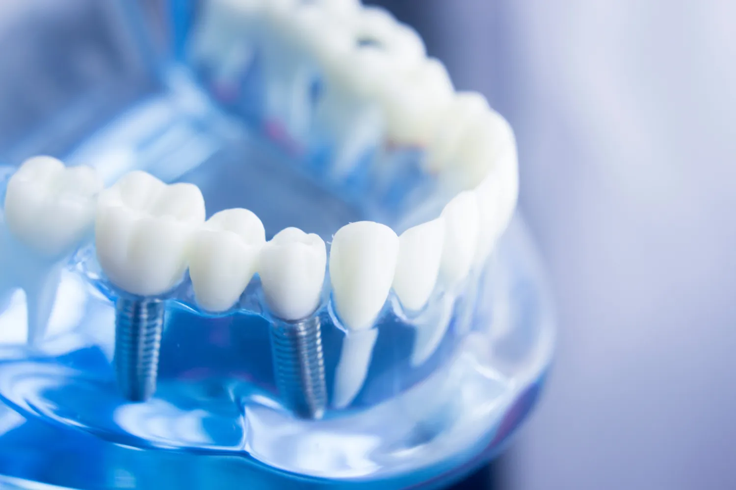 Jakie są rodzaje implantów zębowych?