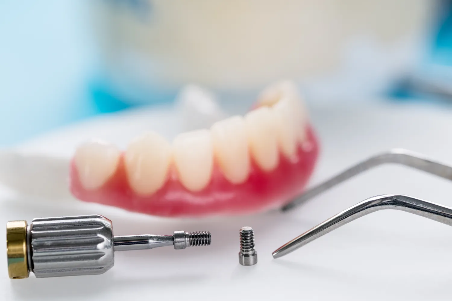 Wszystko co musisz wiedziec o implantach zebowych